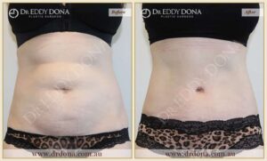 Dr Eddy Dona Plastic Surgery Tummy Tuck Before and After Frontal