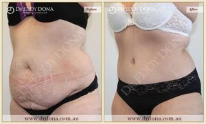 Dr Eddy Dona Plastic Surgery Tummy Tuck Before and After Left Oblique