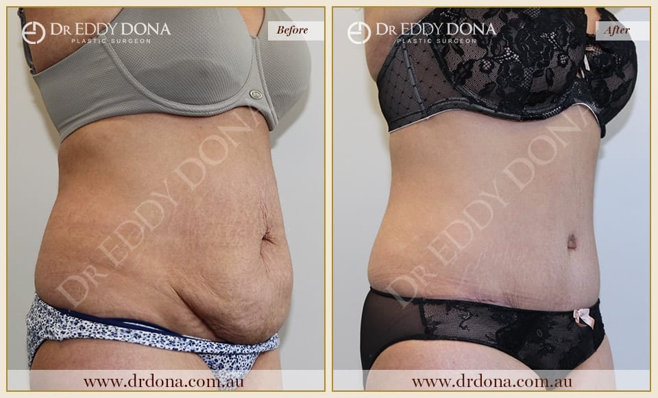 Dr Eddy Dona Plastic Surgery Tummy Tuck Before and After Right Oblique