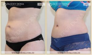 Dr Eddy Dona Plastic Surgery Tummy Tuck Before and After Left Oblique