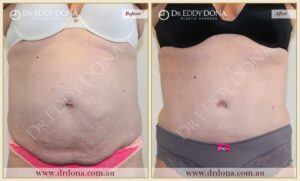 Dr Eddy Dona Plastic Surgery Tummy Tuck Before and After Frontal