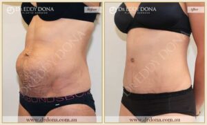 Dr Eddy Dona Plastic Surgery Tummy Tuck Before and After Left Oblique