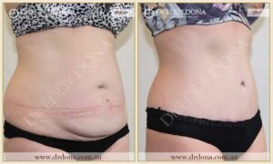 Dr Eddy Dona Plastic Surgery Tummy Tuck Before and After Right Oblique