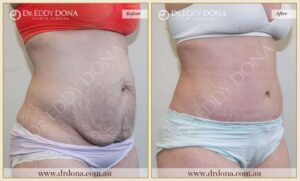 Dr Eddy Dona Plastic Surgery Tummy Tuck Before and After Right Oblique