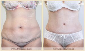 Dr Eddy Dona Plastic Surgery Tummy Tuck Before and After Frontal