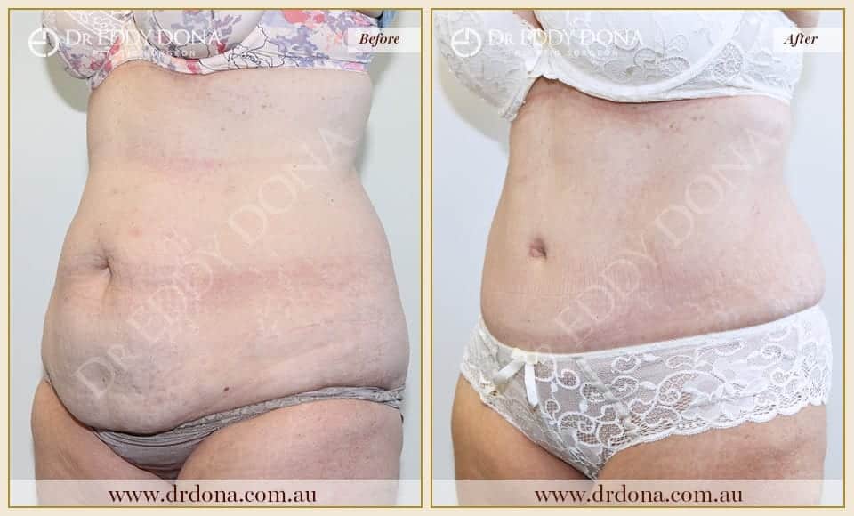 Dr Eddy Dona Plastic Surgery Tummy Tuck Before and After Left Oblique