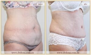 Dr Eddy Dona Plastic Surgery Tummy Tuck Before and After Right Oblique