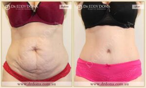 Dr Eddy Dona Plastic Surgery Tummy Tuck Before and After Frontal