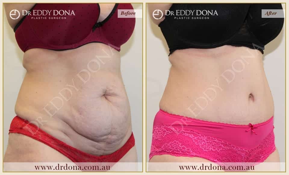 Dr Eddy Dona Plastic Surgery Tummy Tuck Before and After Right Oblique