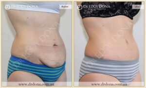 Dr Eddy Dona Plastic Surgery Tummy Tuck Before and After Right Oblique