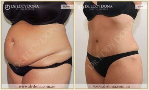 Dr Eddy Dona Plastic Surgery Tummy Tuck Before and After Left Oblique