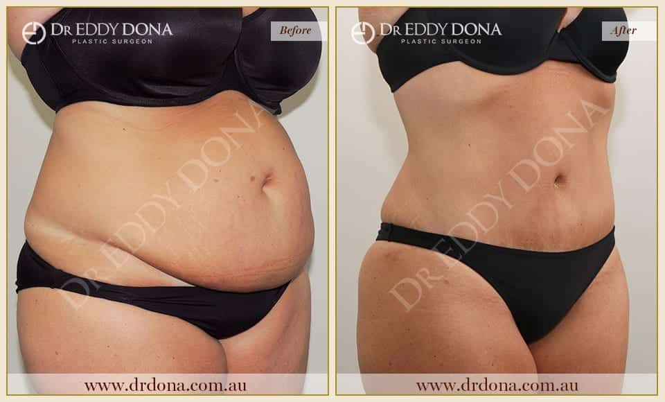 Dr Eddy Dona Plastic Surgery Tummy Tuck Before and After Right Oblique