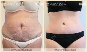 Dr Eddy Dona Plastic Surgery Tummy Tuck Before and After Frontal