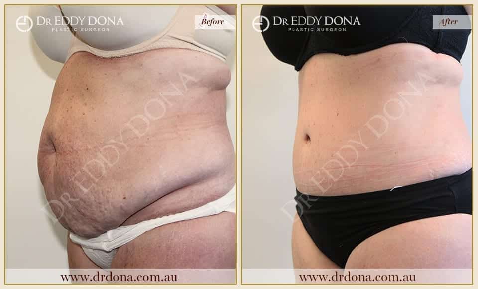 Dr Eddy Dona Plastic Surgery Tummy Tuck Before and After Left Oblique