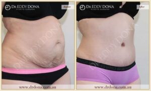 Dr Eddy Dona Plastic Surgery Tummy Tuck Before and After Right Oblique