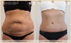 Dr Eddy Dona - Tummy Tuck Surgery - O6632 F-min (2)