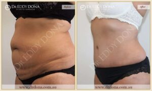 Dr Eddy Dona - Tummy Tuck Surgery - O6632 L-min (2)