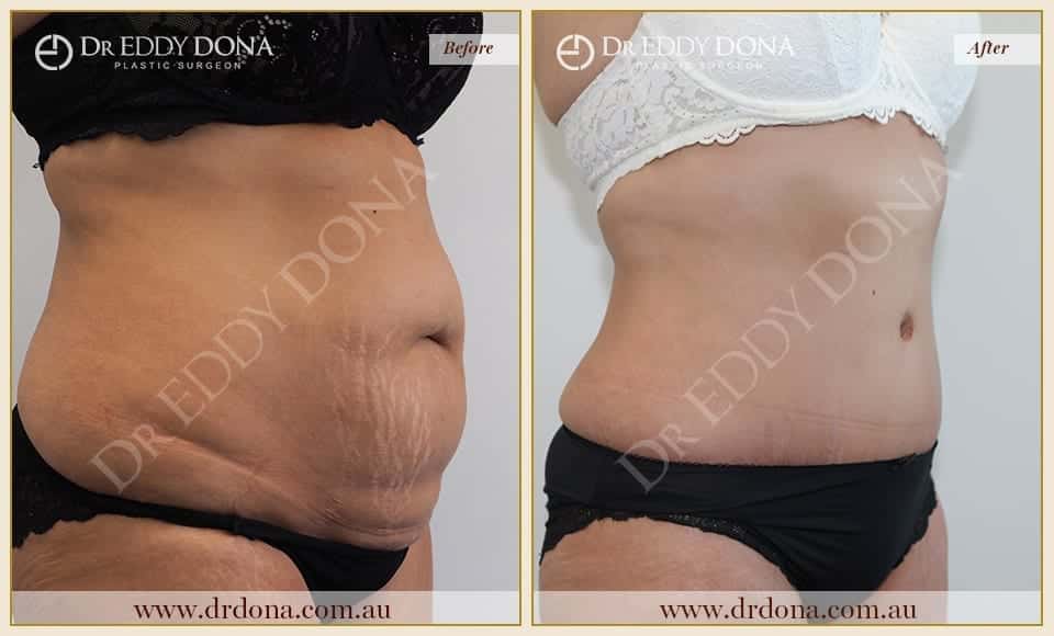 Dr Eddy Dona - Tummy Tuck Surgery - O6632 R-min (2)