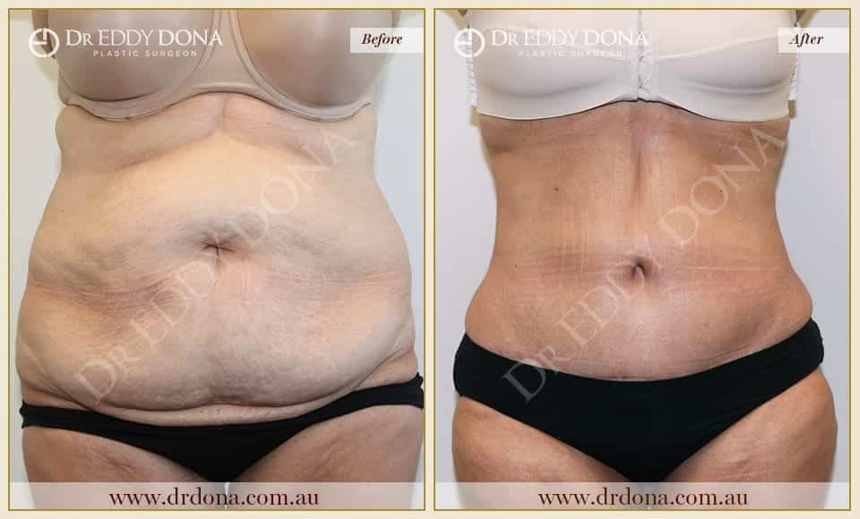 Dr Eddy Dona - Tummy Tuck Surgery - O6751 F-min