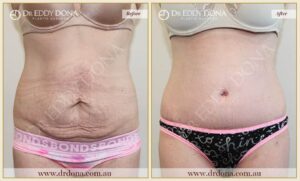 Dr Eddy Dona Plastic Surgery Tummy Tuck Before and After Frontal