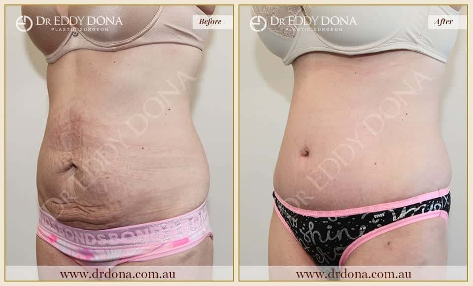 Dr Eddy Dona Plastic Surgery Tummy Tuck Before and After Left Oblique