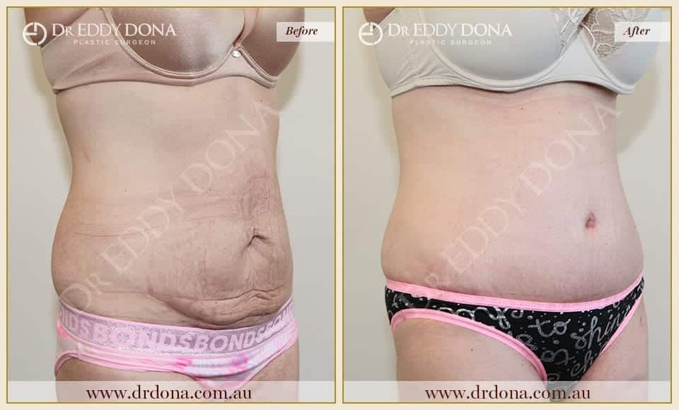 Dr Eddy Dona Plastic Surgery Tummy Tuck Before and After Right Oblique