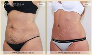 Dr Eddy Dona Plastic Surgery Tummy Tuck Before and After Left Oblique