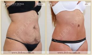 Dr Eddy Dona Plastic Surgery Tummy Tuck Before and After Right Oblique