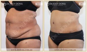 Dr Eddy Dona - Tummy Tuck - Before and After