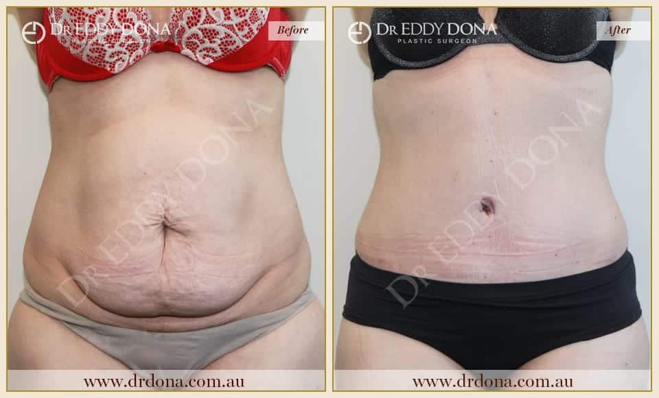 Dr Eddy Dona Plastic Surgery Tummy Tuck Before and After Frontal