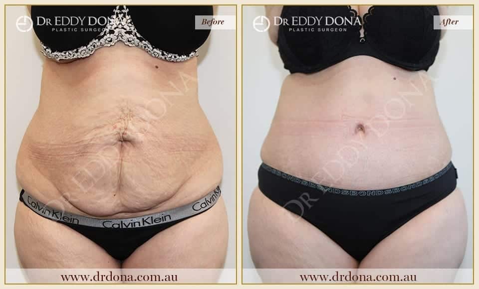 Dr Eddy Dona Plastic Surgery Tummy Tuck Before and After Frontal