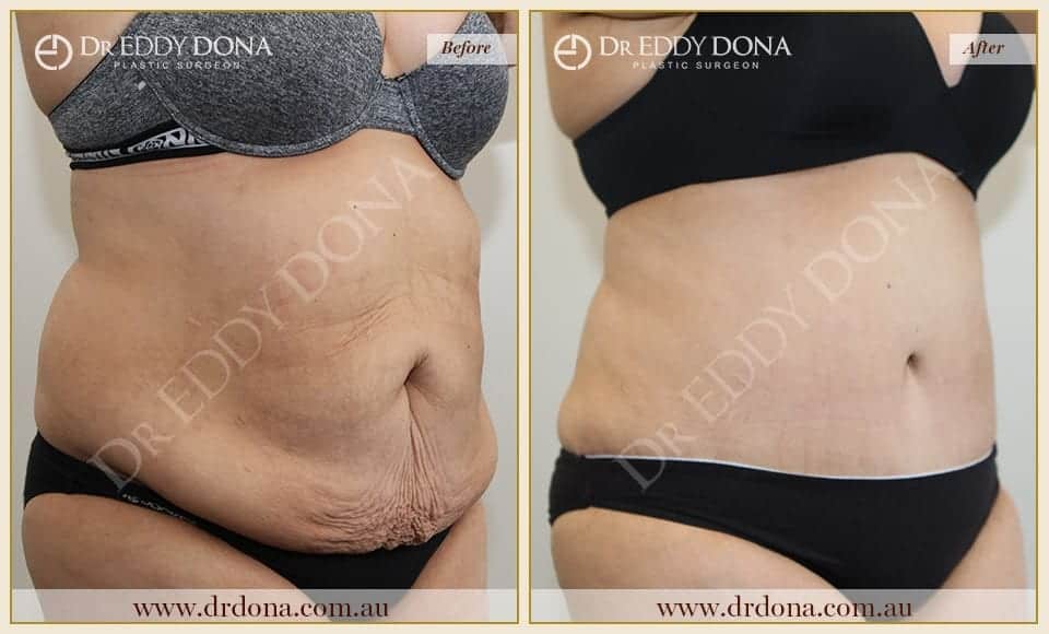 Dr Eddy Dona - Tummy Tucks - O6842 R-min