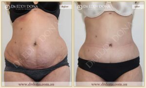 Dr Eddy Dona - Tummy Tuck - Before and After