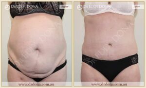 Dr Eddy Dona - Tummy Tuck - Before and After