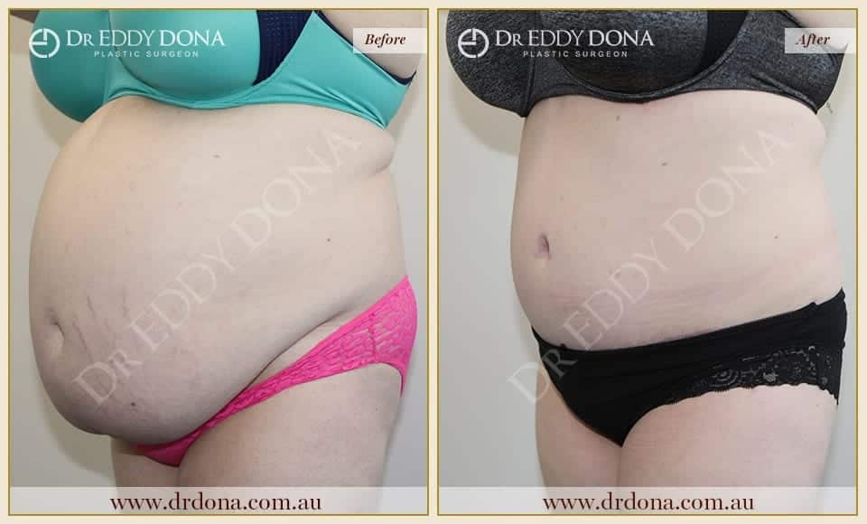 Dr Eddy Dona - Tummy Tucks - O8963 L-min