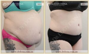 Dr Eddy Dona - Tummy Tucks - O8963 R-min