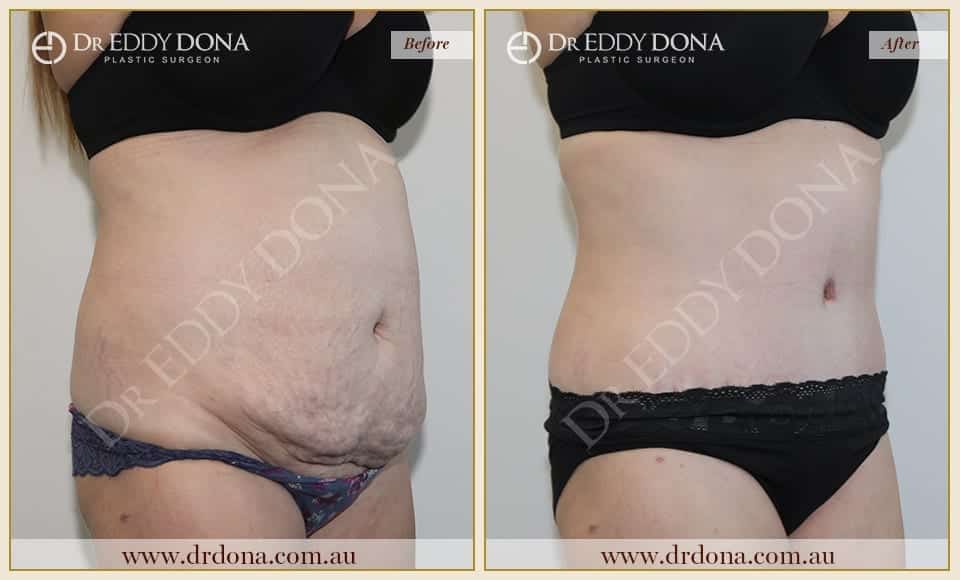 Dr Eddy Dona - Tummy Tuck - Before and After