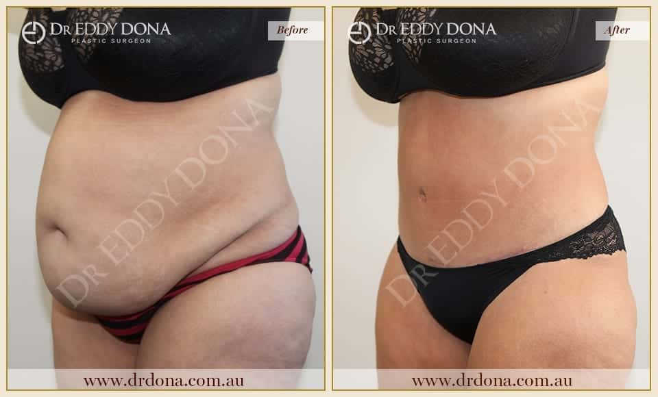 Dr Eddy Dona - Tummy Tuck - Before and After