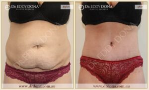 Dr Eddy Dona - Tummy Tuck - Before and After