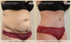 Dr Eddy Dona - Tummy Tuck - Before and After