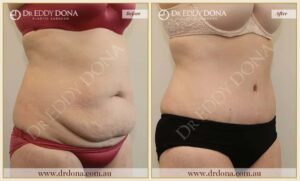 Dr Eddy Dona - Tummy Tuck - Before and After