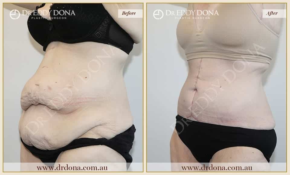 Dr Eddy Dona - Tummy Tuck - Before and After